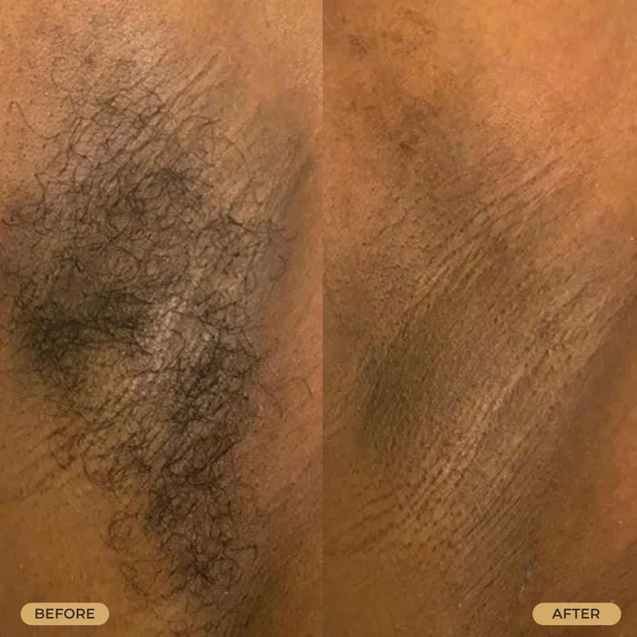 B&C Skin Tight Ingrown Hair & Razor Bump Creme