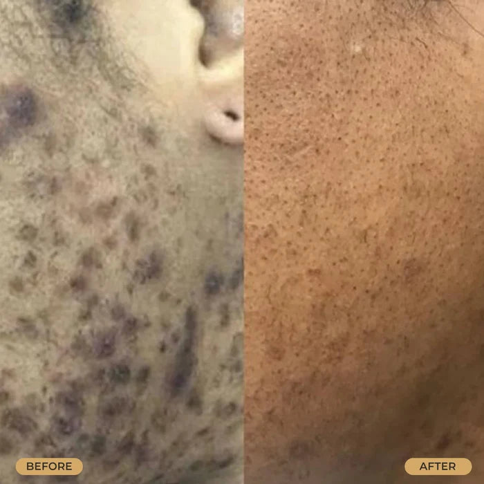 B&C Skin Tight Ingrown Hair & Razor Bump Creme